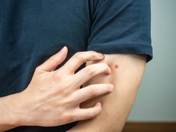 Bug bite on a man's arm
