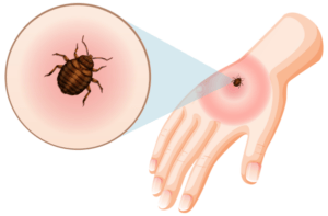 Bed bug bite