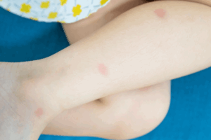 Insect bites on child leg